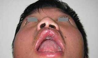 修复手术多少钱 修复手术多少钱